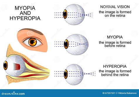 Myopia, Short Sighted Eye Cartoon Vector | CartoonDealer.com #52791175