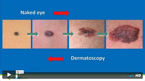 How to manage benign skin lesions which mimic or hide skin cancers