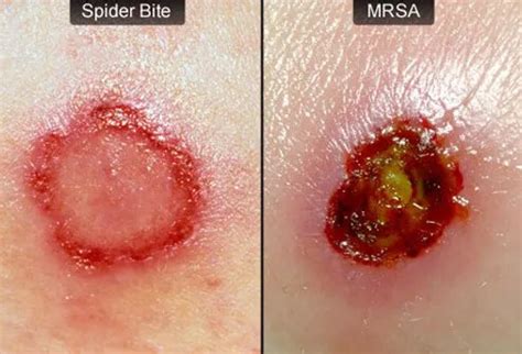 MRSA Infection: Causes, Symptoms, and Treatment