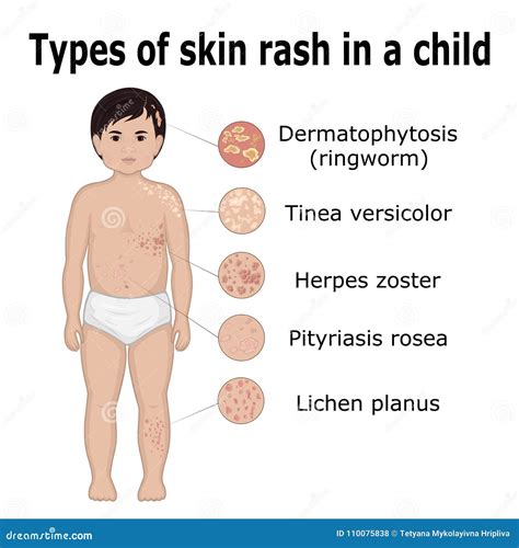 Types of Skin Rash in a Child Stock Vector - Illustration of dermatology, herpes: 110075838