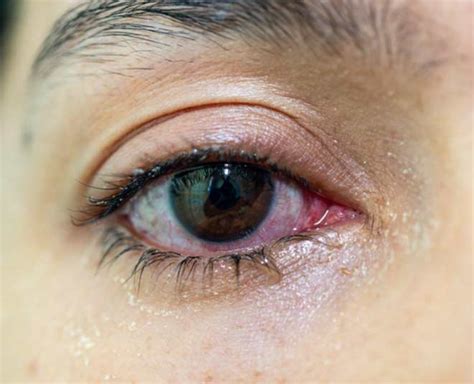 Expert Shares Home Remedies To Treat Watery Eyes | HerZindagi