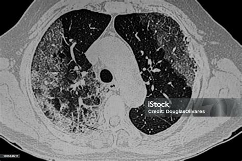 Chest Ct Scan Of Novel Coronavirus Covid19 Stock Photo - Download Image Now - Adult, Black And ...