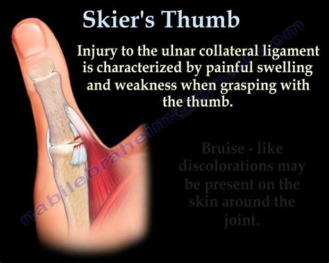 Gamekeeper’s Thumb (UCL Tear) - Carolina Regional Orthopedics