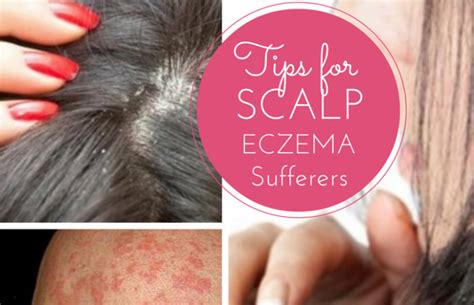 Tips for Effectively Managing and Minimising Symptoms of Scalp Eczema - Mum's Lounge