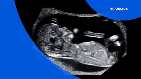 13-Week Ultrasound: Pictures, Gender Prediction and Baby's Growth