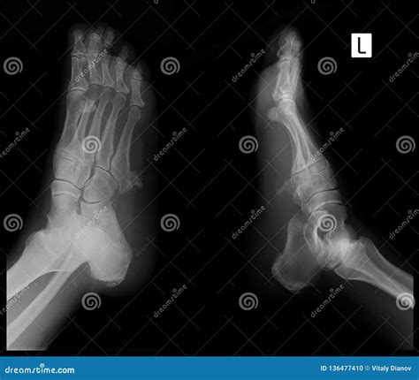 Foot Mri Metatarsal Shaft Stress Fracture Collage Royalty-Free Stock Photography | CartoonDealer ...