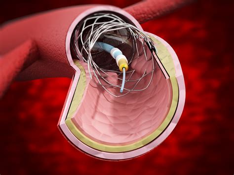 Coronary stent implantation (PCI) | CardioQinetics Heart Clinic