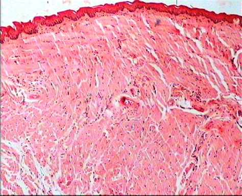 The squamous epithelium, sub-mucosal and tongue muscle is normal in... | Download Scientific Diagram