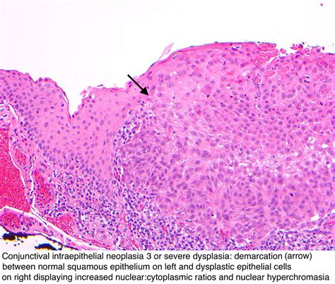 Pathology Outlines - Conjunctival intraepithelial neoplasia