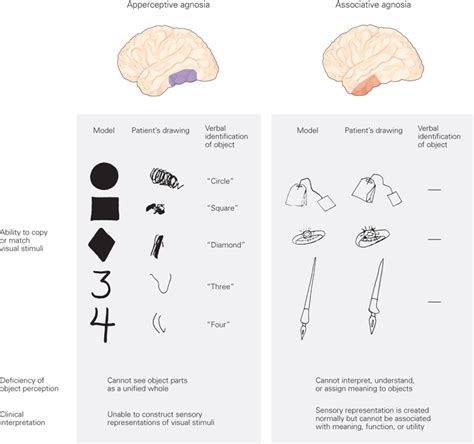 👍 Apperceptive agnosia. Associative Agnosia Video. 2019-02-20