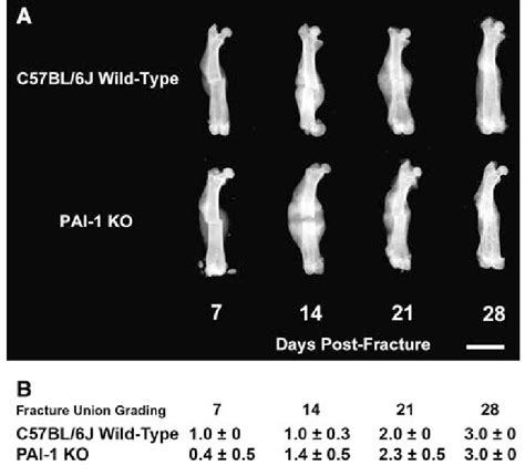 Fracture healing radiology. (a) Healing was examined by Xray in... | Download Scientific Diagram