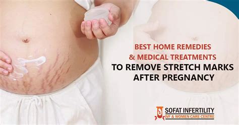 How To Remove Stretch Marks After Pregnancy At Home - PregnancyWalls