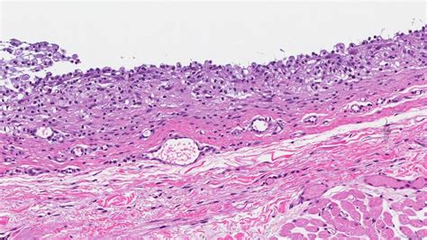 Mucocele Histology