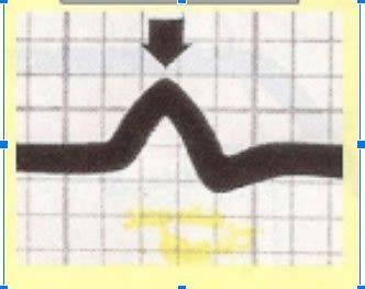 EKG Strip Matching Flashcards | Quizlet