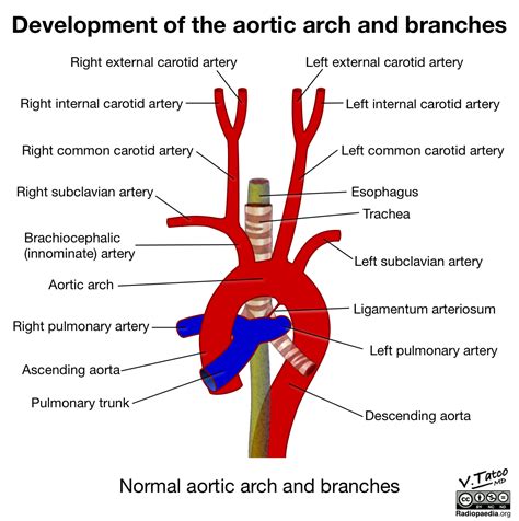 Radiopaedia - Drawing Aortic arch and its branches - English labels ...