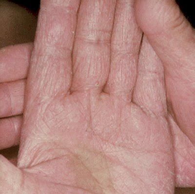 Fungal Infection Images - Tinea Manuum