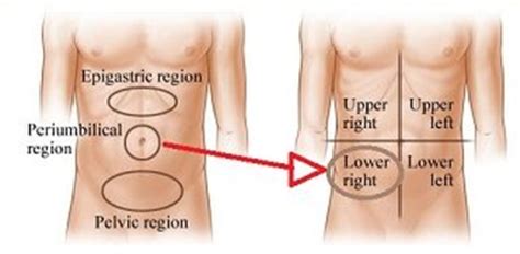 Appendix Pain - Location, Symptoms, Treatment and Surgery | HubPages