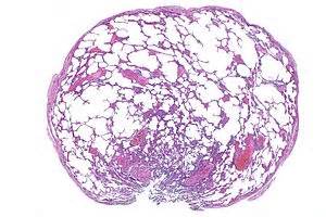 Lung bleb - Libre Pathology