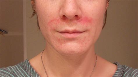 Amazing Home Remedies for Perioral Dermatitis - Yabibo