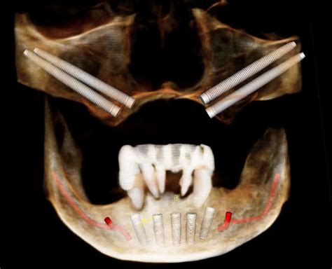 Zygomatic Dental Implants - Burbank Dental Implants - Dr. Amin