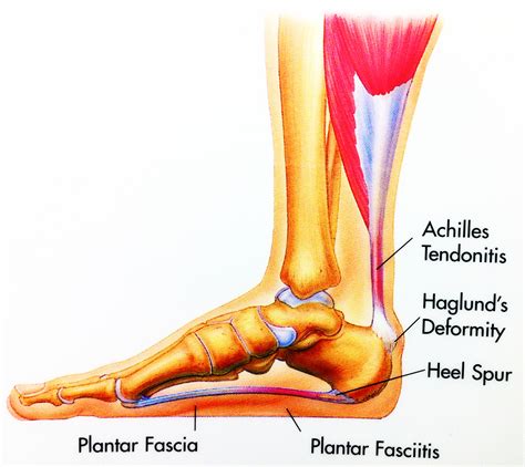 Calcaneal Spur: Symptoms And Treatment | Download Team