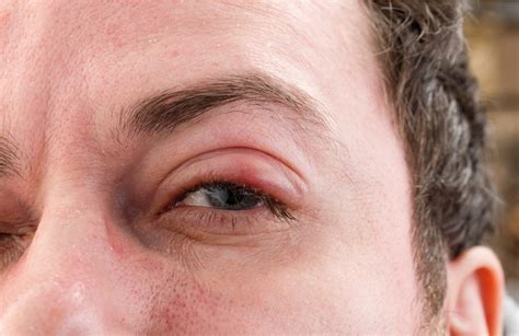 Trachoma: Causes, Symptoms, and Treatment