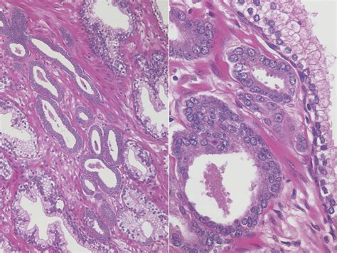 Adenocarcinoma Prostate