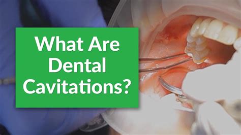 What Are Dental Cavitations & How Are They Treated? - YouTube