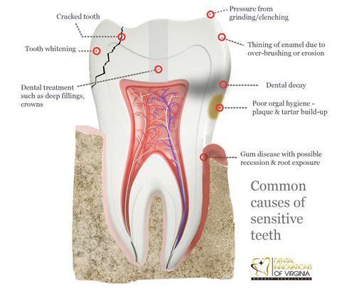 Sensitive Teeth or Sensitive Gum? - Lansdowne, VA Family Dentistry