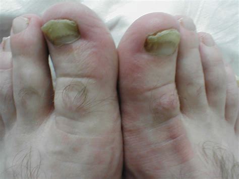 Onychomycosis physical examination - wikidoc