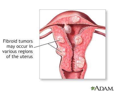 Abdominal mass Information | Mount Sinai - New York