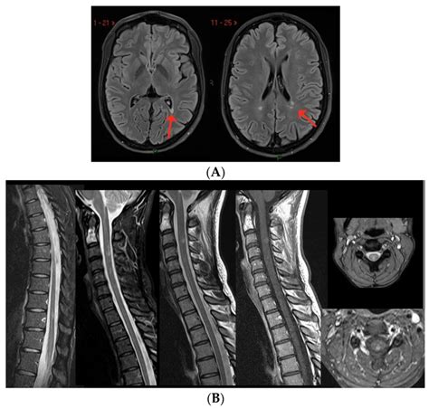 (A) Three new non-enhancing lesions in the periventricular white... | Download Scientific Diagram