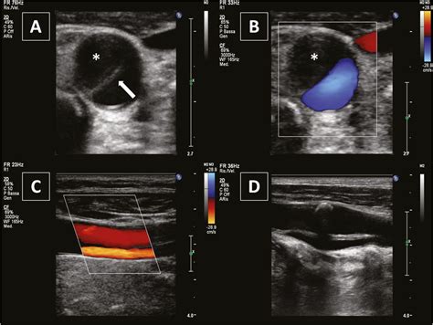 Common Carotid Artery Dissection