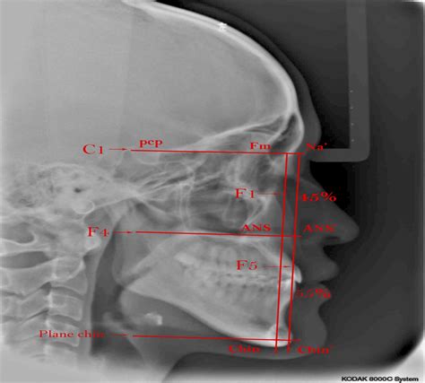 Treatment Protocol and Surgical Techniques for Macrogenia : Journal of Craniofacial Surgery