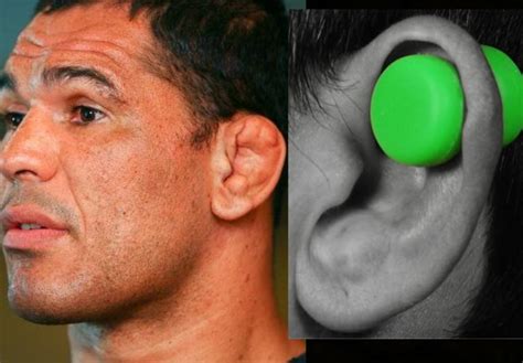 Preventing Cauliflower Ear with Caulicure