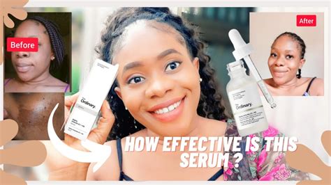 The Ordinary Alpha arbutin 2%+ ha for clearing Dark Spots ? | before and after photos - YouTube