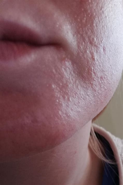 [Skin concerns] Very tiny bumps on face after retinol use - purging or allergy? : r ...