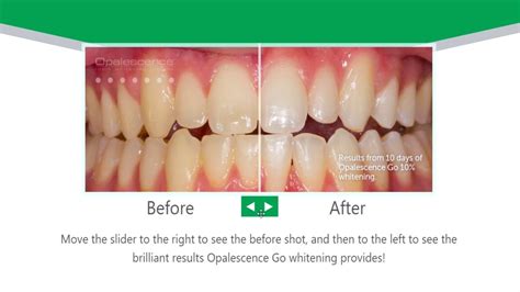 Opalescence Go - Take Home Teeth Whitening - YouTube