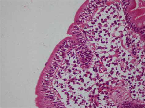 Photomicrograph showing increased intraepithelial lymphocytes (H&E x... | Download Scientific ...