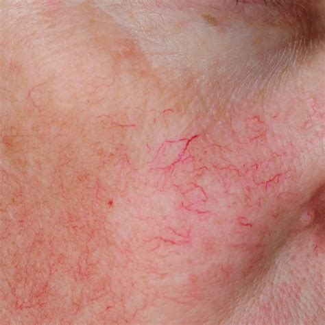 Telangiectasia and rosacea | Spot Check Clinic