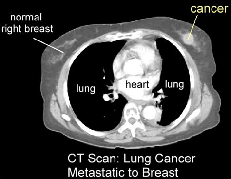 Breast Cancer Imaging