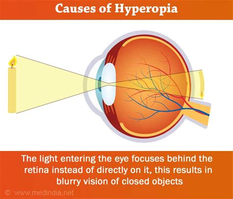 What are the Causes of Hyperopia?