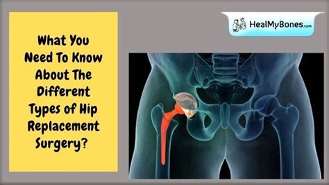 What You Need To Know About The Different Types of Hip Replacement Surgery? in 2021 | Hip ...