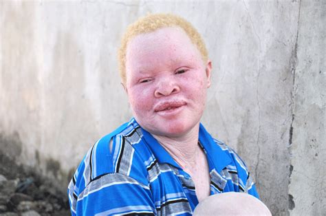 Albinos of Tanzania | Safari Junkie