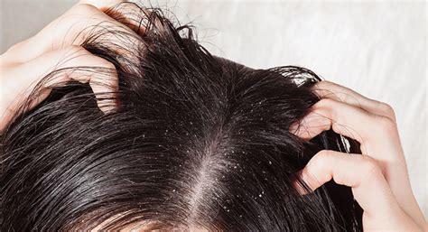 Hair fungus Treatment, Causes, Symptoms & Preventions