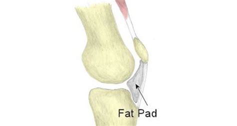 Knee Fat Pad Impingement - Symtpoms, Causes and Treatment