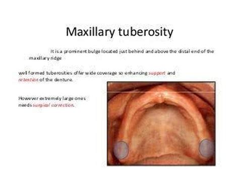 Maxillary Tuberosity Anatomy