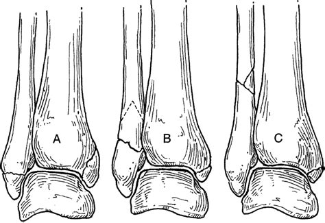 Weber Classification Ankle Fracture