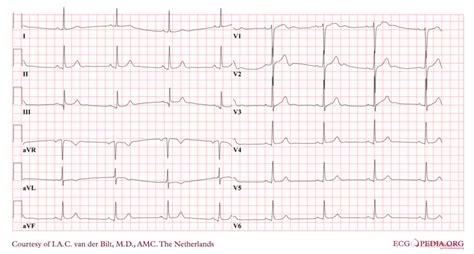 Sinus bradycardia electrocardiogram - wikidoc