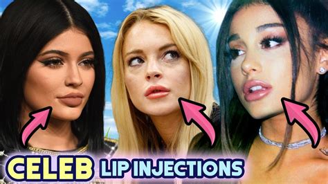 Actresses With Lip Fillers | Sitelip.org